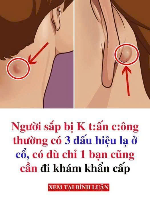 Người sắp bị UT thường có 3 dấu hiệu lạ ở cổ, có dù chỉ 1 bạn cũng cần đi khám khẩncấp